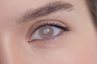 Woman-with-Cataracts