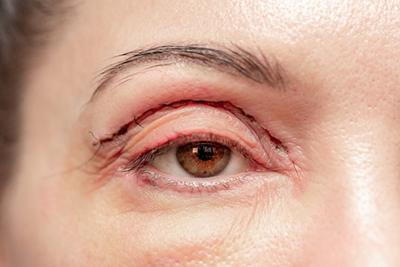 Close-up-of-stitched-eyelid-post-surgery