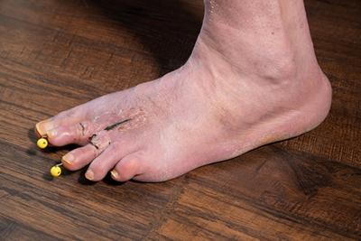 Foot-After-Hammertoe-Surgery
