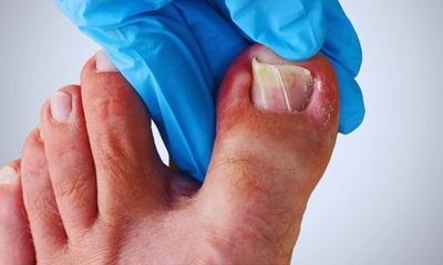Gloved-hand-examining-infected-ingrown-toenail