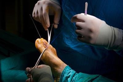 Surgeon operating on patient’s toe to correct hammertoe deformity