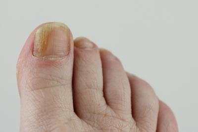 Illustration of Fungal Toenail on a person