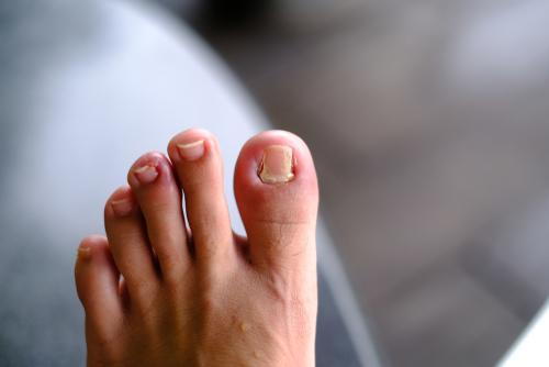 Close-up of a foot showing an ingrown toenail after surgery.