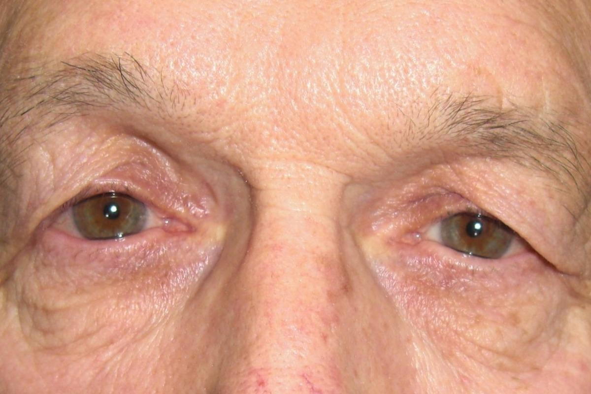 Droopy eyelids due to excess eyelid skin