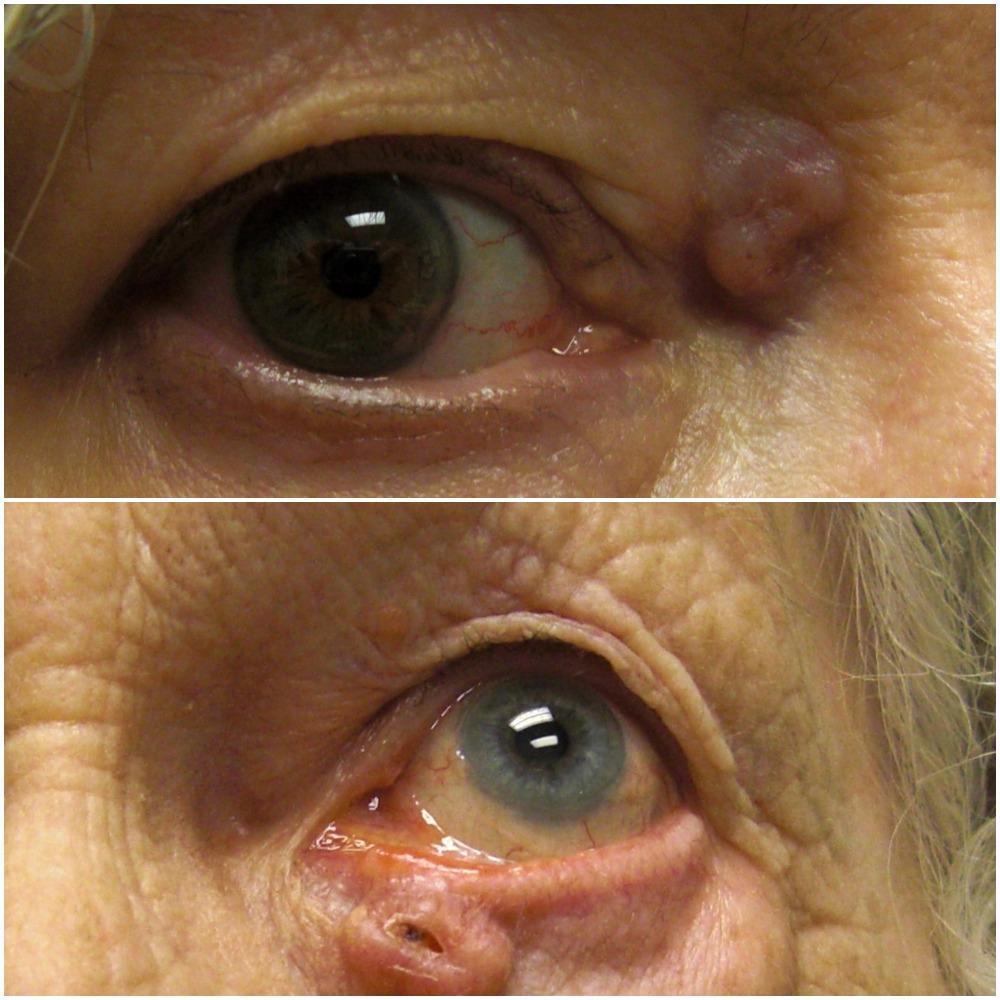 Skin Cancer On Eyelid Symptoms 