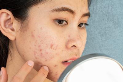 Close-up of woman checking acne on cheek in mirror