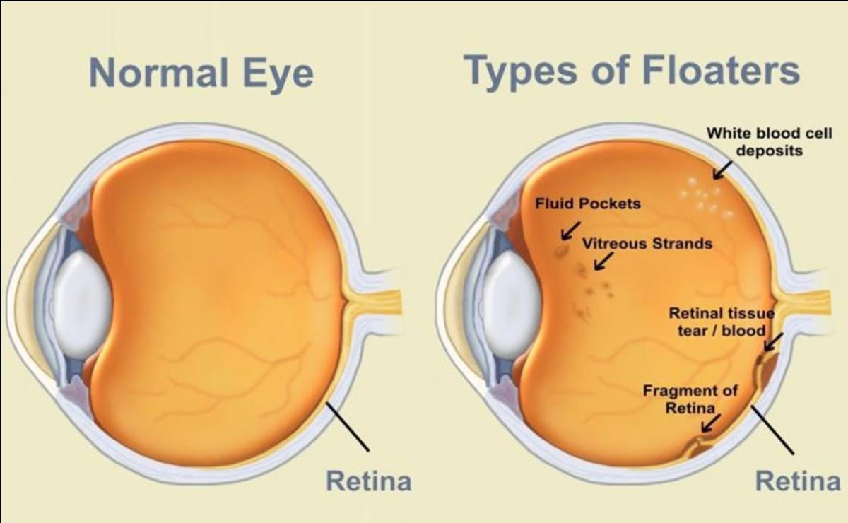 detached retina flashes
