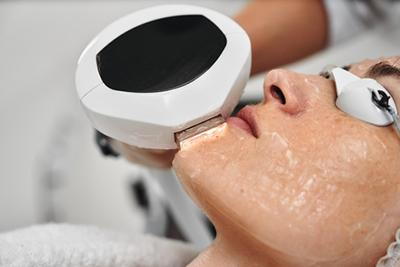 Intense-Pulsed-Light-IPL-treatment