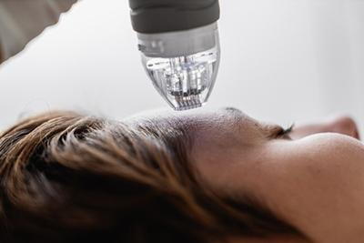 Microneedling-Treatment-for-Hyperpigmentation