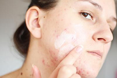Woman put some cream on her face with acne.