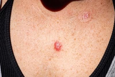 Skin lesion on patient skin with redness