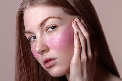 Close-up of female patient showing facial redness from rosacea