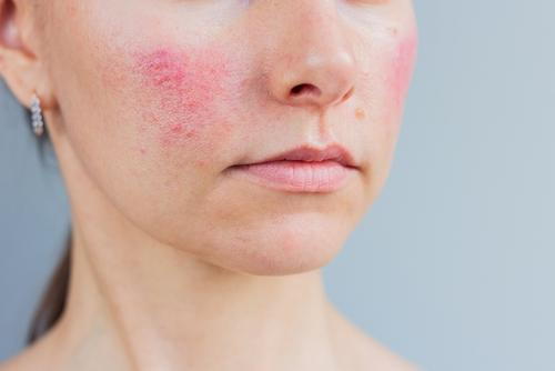 Female patient displaying facial rosacea