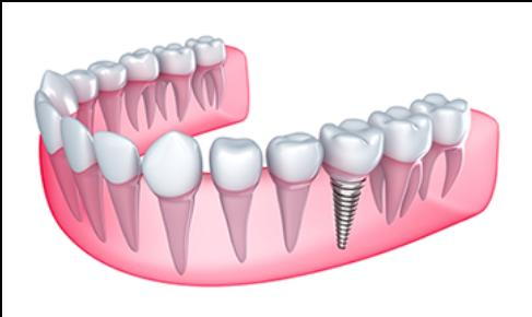 Dental Implants in Harrisburg, PA