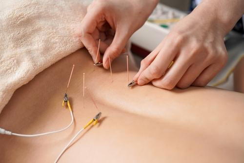 Woman undergoing electrical stimulation acupuncture treatment for pain relief and wellness