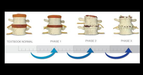 The 3 Stages Of Spinal Degeneration   Heroimage0.924010001543950411 