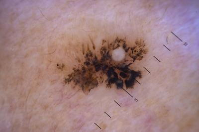 Melanoma-a-Malignant-Tumor-of-Skin