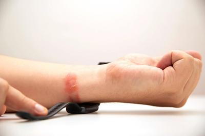 Contact-Dermatitis-from-Fitness-Bracelet