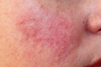 Woman-with-Rosacea