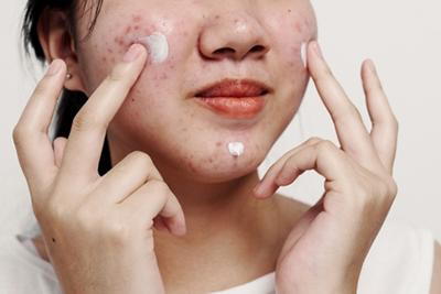 Woman-with-Acne-Problems