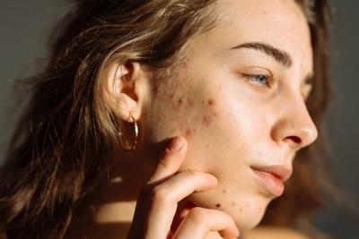Close-up-of-a-woman-with-acne-touching-her-face-gently