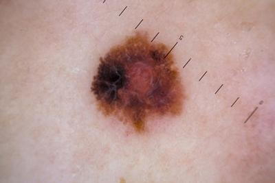 Close-up image of melanoma on human skin for dermatology reference