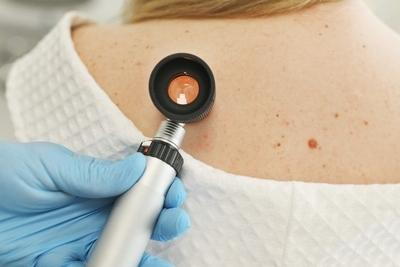 Doctor using Dermatoscope to check skin conditions.