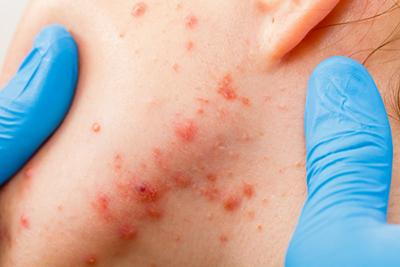 Illustration of Cystic Acne on skin