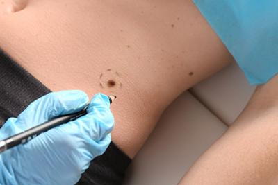 Illustration of mole on skin of a patient marked by the doctor