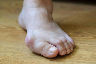 Person with bunions condition in foot.