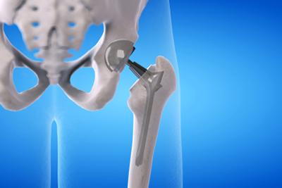 Total-Hip-Replacement-Illustration