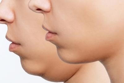Reconstructive Plastic Surgery low jaw