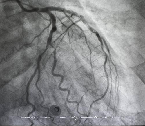 Left coronary angiography showing coronary arteries