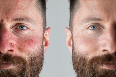 Visible results of rosacea treatment in man, comparison of red, irritated skin and clearer complexion