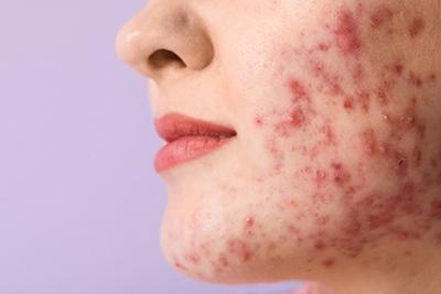 Woman with severe acne on her face