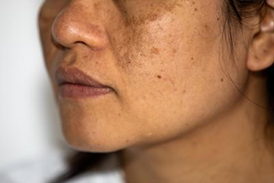 Illustration of age spots on skin