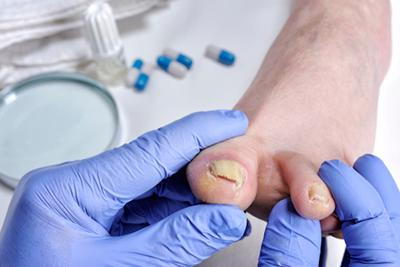 Foot doctor checking patient’s toenail for fungal infection