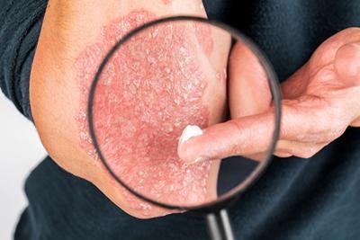 Man-Applying-Topical-Cream-to-his-Psoriasis
