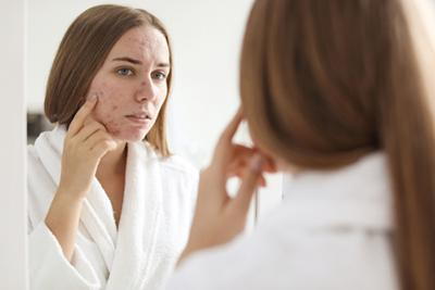 Concerned-Woman-Observing-Acne-on-Her-Face