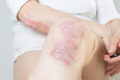 Close-up-of-psoriasis-patches-on-a-person's-knee.