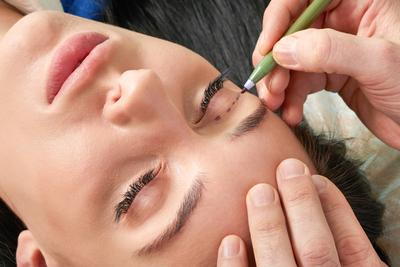 Illustration of Eyelid Surgery before