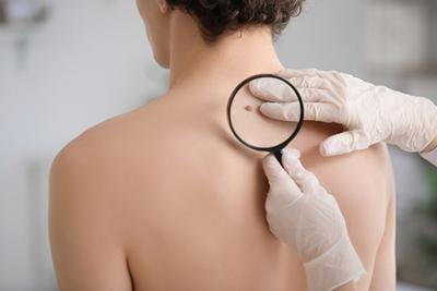Mole-Screening-with-Skin-Doctor