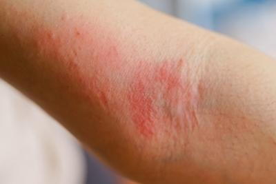 Illustration of skin allergy on skin with severe redness