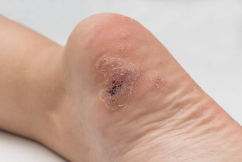Plantar wart close up on the bottom of foot heel caused by human papillomavirus