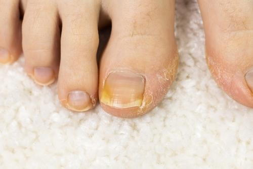 Close-up of a toenail affected by fungal infection with yellowish and brittle appearance