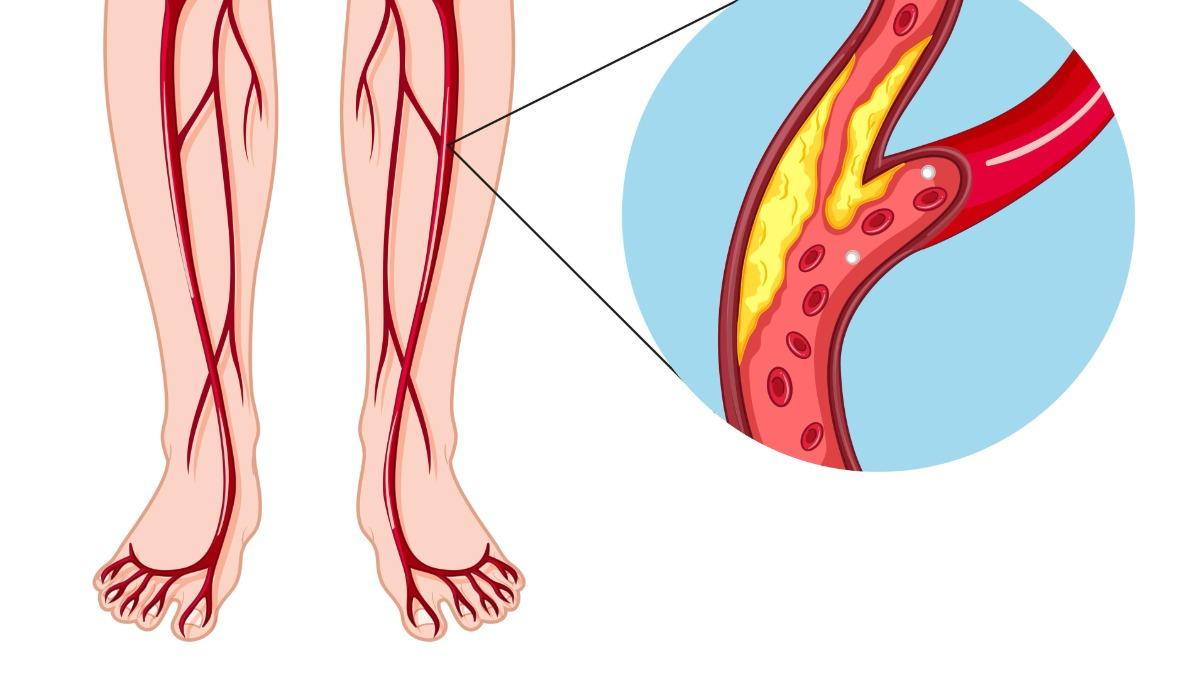 Peripheral Arterial Disease