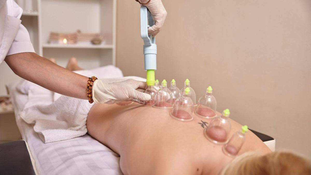 All you need to know about Cupping therapy