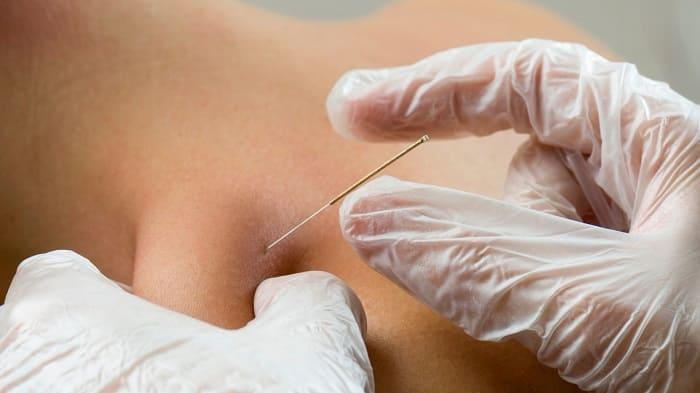 What Is Dry Needling Therapy?