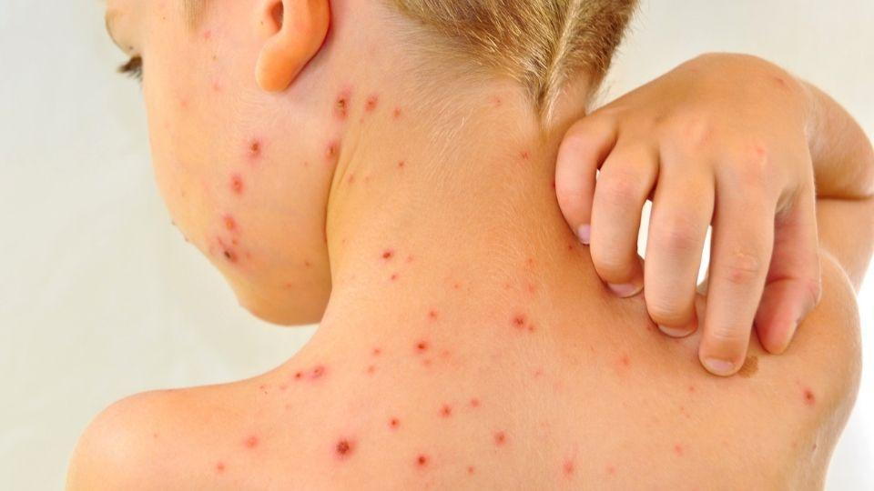 Can You Get Shingles if You've Never Had Chickenpox?