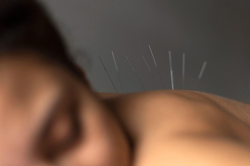 How Long Does It Take for Acupuncture to Work?